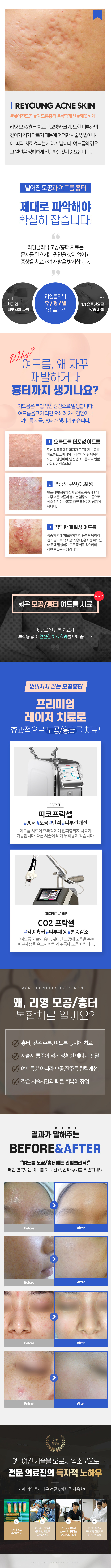 없어지지 않는 모공흉터, 프리미엄 레이저 치료로 효과적으로 모공/흉터를 치료!