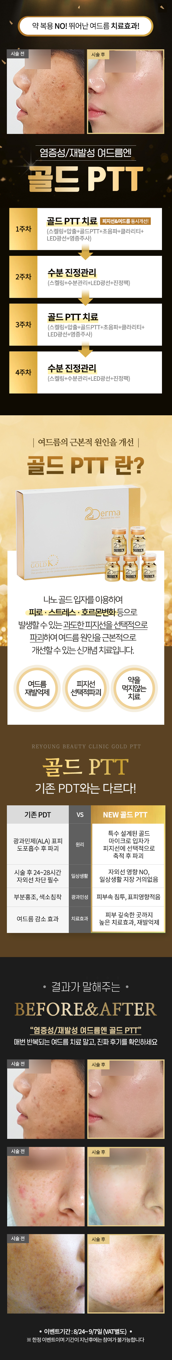 약  복용 NO! 뛰어난 여드름 치료효과! 염증성/재발성 여드름엔! 골드 PTT