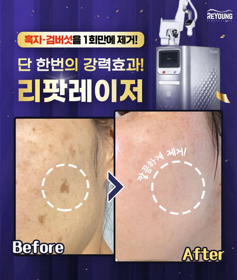 리팟레이저