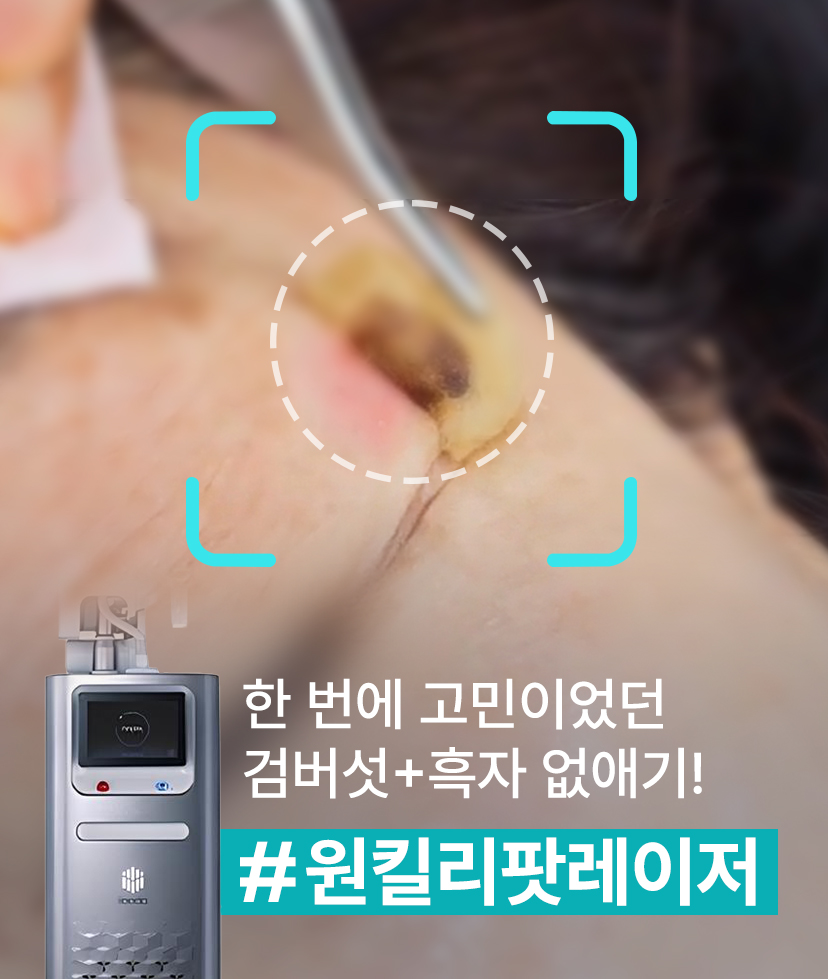리영클리닉 한번에 고민이었던 검버섯+흑자 없애기! 원킬리팟레이저 이벤트